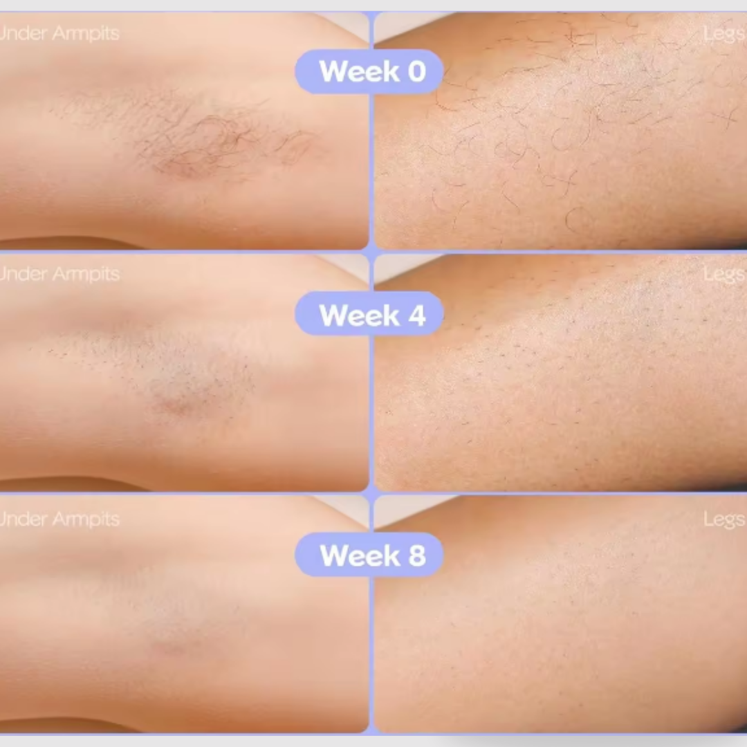 GlowUps IPL Laser Hair Removal